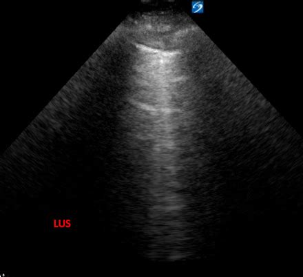 Ahmed T Abdellah On Twitter Pocus Pt S P Cabg With Ef