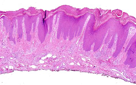 Eczema Herpeticum Pathology Outlines At Paullbatemano Blog