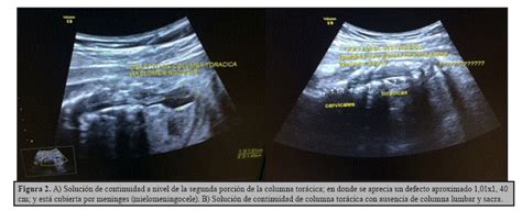 Revista Scientifica S Ndrome De Bandas Amni Ticas Asociado A