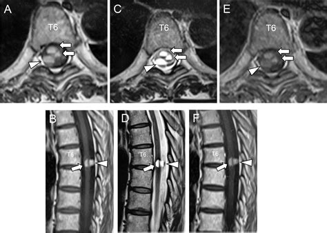 Intramedullary Cavernous Hemangioma Of The Spinal Cord With Intra And