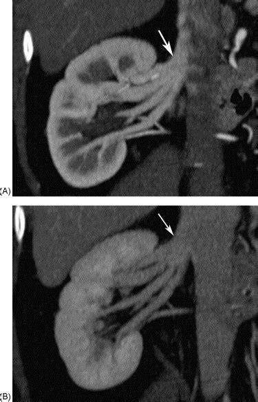 Multidetector Row Ct Angiography Of Living Related Renal Donors Is