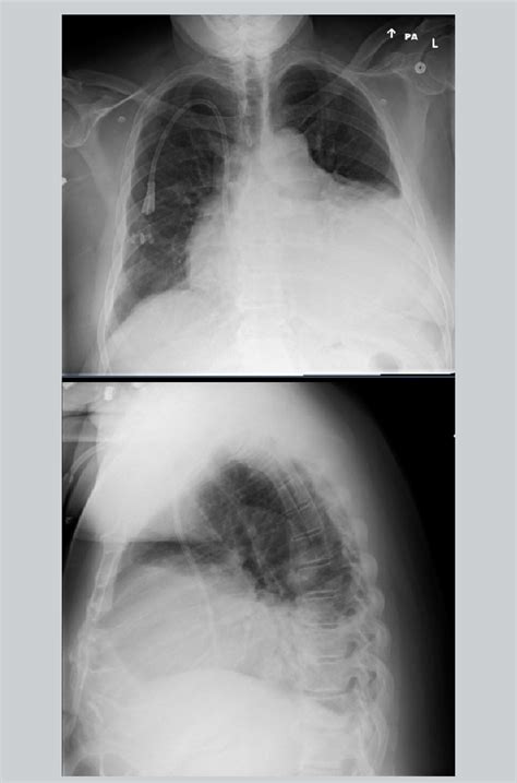 Two View Chest X Ray Showing Massive Cardiomegaly Vs Obscuration Of