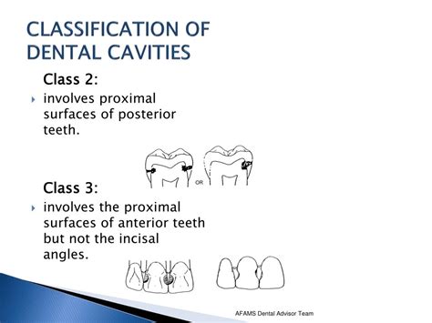 Ppt Classification Of Dental Cavities Preparations And Restorations