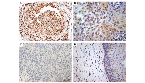 Expression And Correlation Of NRF2 KEAP1 NQO 1 And HO 1 In Advanced