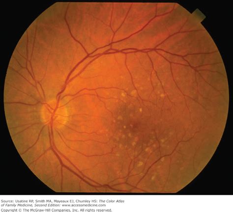 Stages Of Macular Degeneration