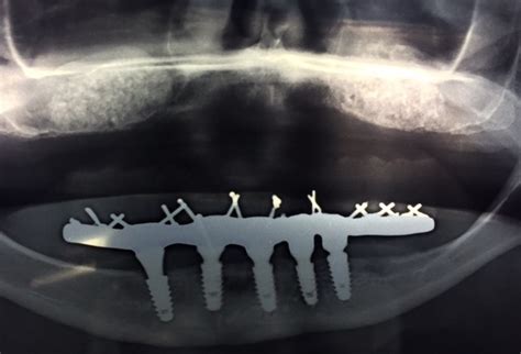 Levantamento Do Seio Maxilar Sinus Lift Alex Albanese Odontologia