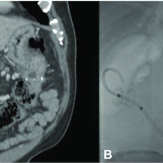 Magnetic Resonance A And EUS B Images Of Distended Gallbladder Due