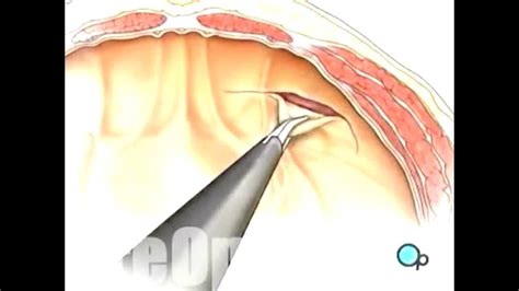 Hérnia Inguinal Cirurgia Por Videolaparoscopia Youtube