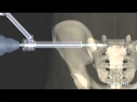 Ifuse Implant System Minimally Invasive Sacroiliac Joint Surgery