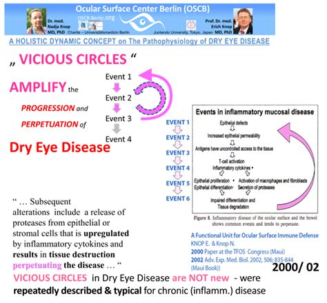 Glimpse On Dry Eye Disease — Ocular Surface Center Berlin