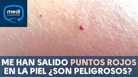 Me Han Salido Puntos Rojos En La Piel ¿son Peligrosos Mediconsultas