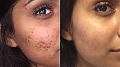 Cystic Acne Scars