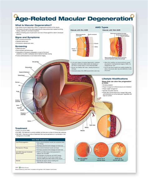 Age Related Macular Degeneration Anatomy Poster Clinicalposters