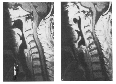 Figure 2 From Acute Epidural Abscess Of The Cervical Spine Caused By