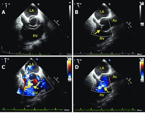 A Transesophageal Echocardiography Tee Mid Esophageal Short Axis