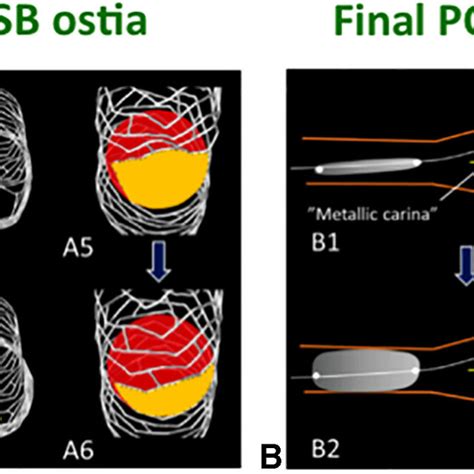 Final Pot Balloon Position And Assessment Of The Cell Opening Area