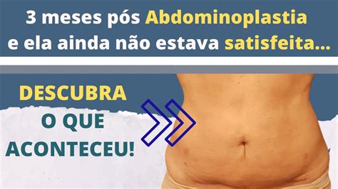 Fiz Abdominoplastia E A Barriga Está Estufada - Resultados de Abdominoplastia: como melhorar o seu abdome! - YouTube