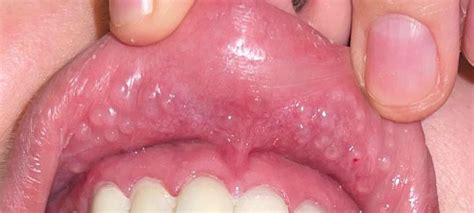 Clear liquid filled bumps on upper lip after dentist? : r/askdentists