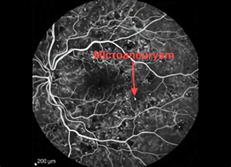 Diabetic Macular Edema Fluorescein Angiography