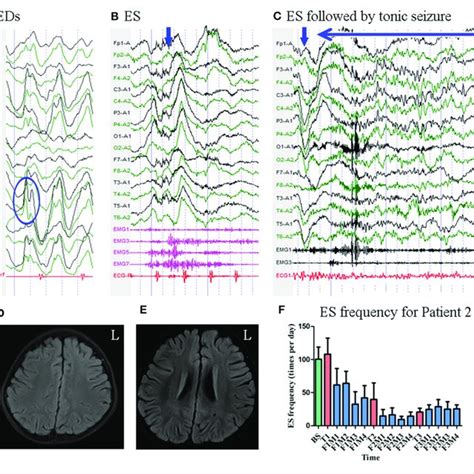 The EEG MRI And Seizure Frequency For Patient 1 A Interictal EEG