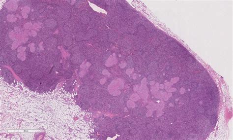 Locally Advanced Breast Cancer With Lymphatic Invasion Bosnianpathology