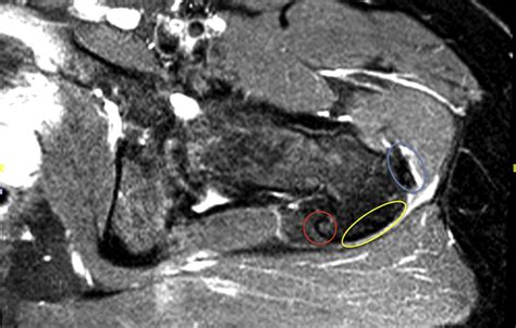 Imaging Of Abductor Tears Stepwise Technique For Accurate Diagnosis Arthroscopy Techniques