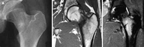 The management of an undisplaced compression sided femoral neck stress ...