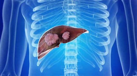 Liver Cancer Glyph Icon Animation Stock Footage Video Of Cirrhosis