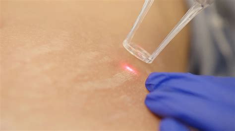 Laser Cosmetic Surgery Skin Resurfacing In Stock Footage SBV-348452766 ...