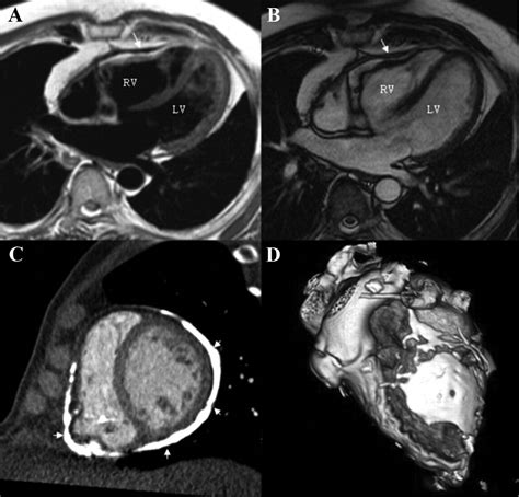 Constrictive Pericarditis Mri