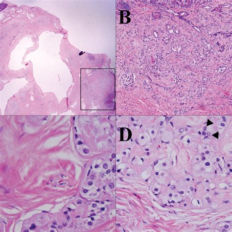 Histochemical And Electron Microscopic Features Of The Tumor The