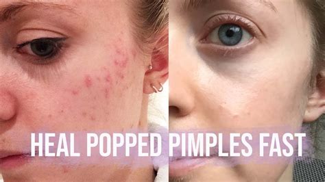 Neat Info About How To Quickly Heal A Pimple - Curvecelebration