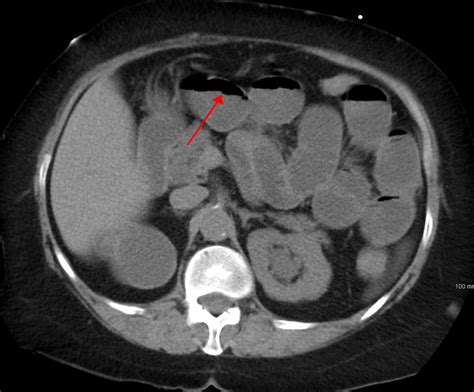 Bowel Obstruction Causes Management Teachmesurgery