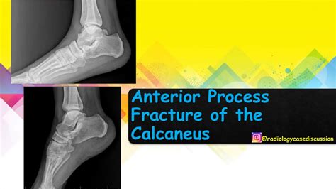 27 Radiological Imaging Of Anterior Process Fracture Of The Calcaneus