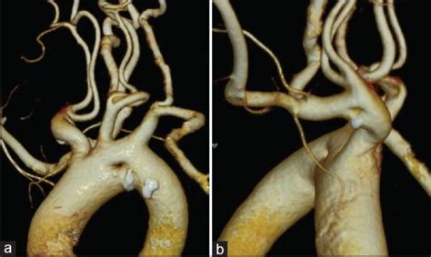 Double Lumen Aortic Arch With Double Lumen Brachiocephalic Artery