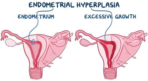 Endometrial Hyperplasia Types Causes Symptoms Diagnosis Treatment