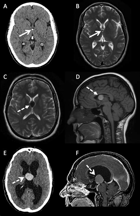 Varying Imaging Features Of Colloid Cysts A Axial Ct Scan And B