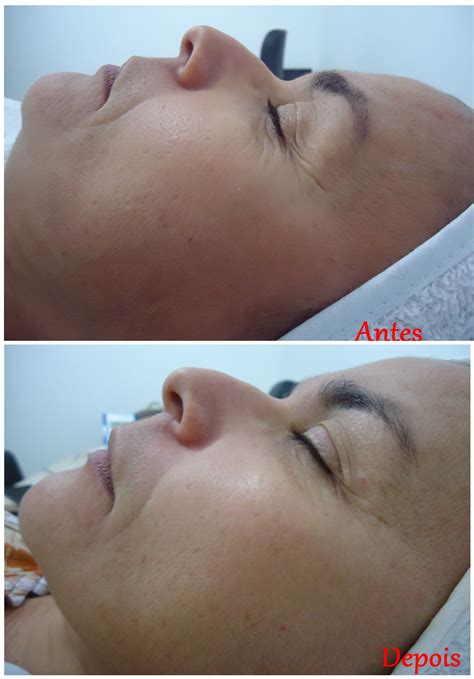 Peeling De Clareamento Sinta Sua Pele Renovada Hidratada E Iluminada