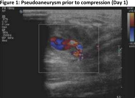 Figure 1 From Radial Artery Pseudoaneurysm Managed By Prolonged