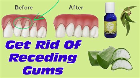 How To Grow Back Your Receding Gums With These Natural Remedies Best