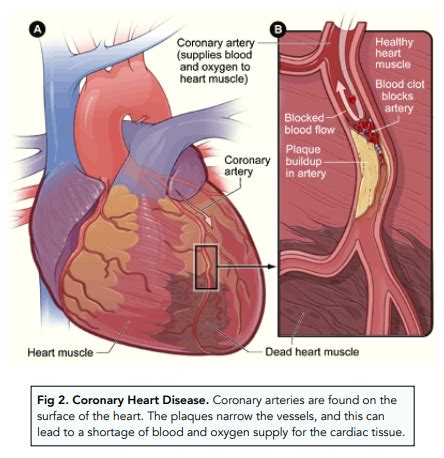 Cardiovascular Disease Stents And Lifestyle GCSE Biology Study Mind