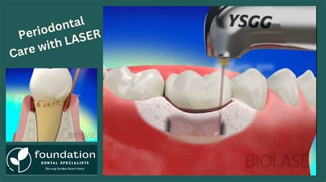 Find Out How A Laser Can Treat Periodontal Disease Less Invasive And