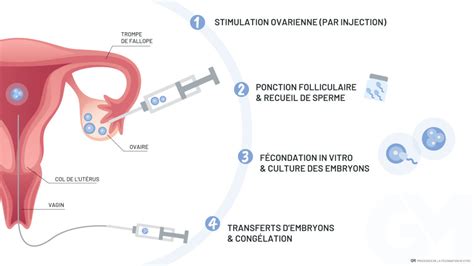 fecondation in vitro marseille GynécoMarseille