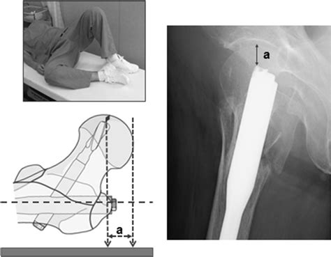 A Refined Definition Improves The Measurement Reliability Of The Tip