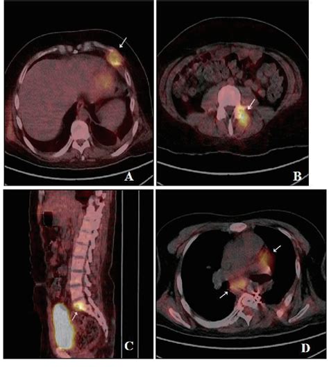 Figure From Multifocal Skeletal Tuberculosis Presenting As Paraplegia