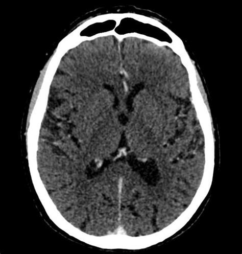 Fornix Mri