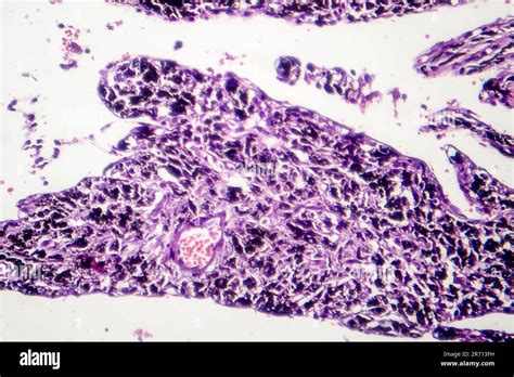 Smoker S Lung Histopathology Light Micrograph Showing Accumulation Of