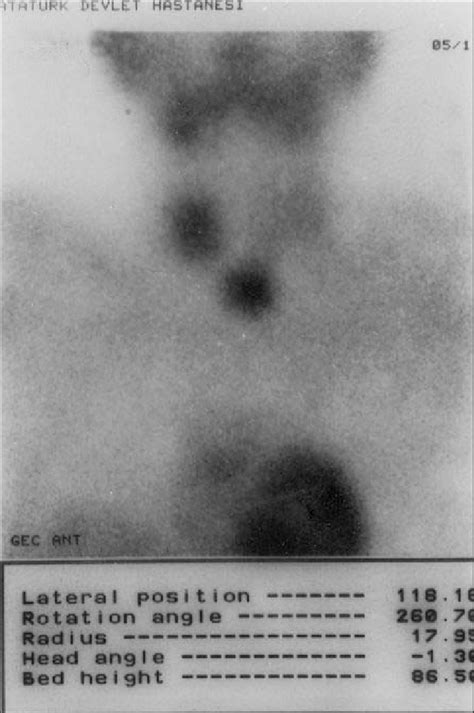 Technetium Tc M Sestamibi Scan Demonstrating Uptake In Glands