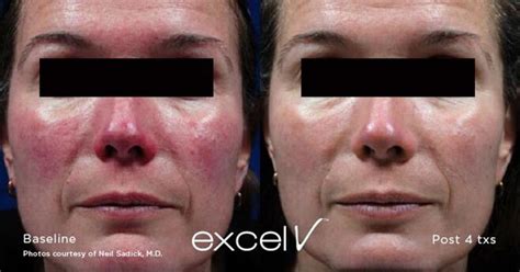 Rosacea Treatment And Laser Face Treatments Melbourne Mole Check Clinic