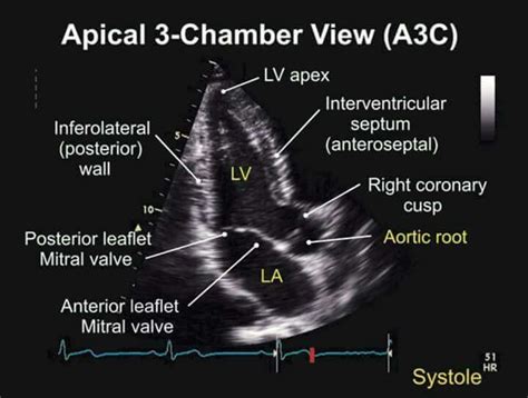 Pin By Didi Ramos On Ultrasound Cardiac Sonography Echocardiogram